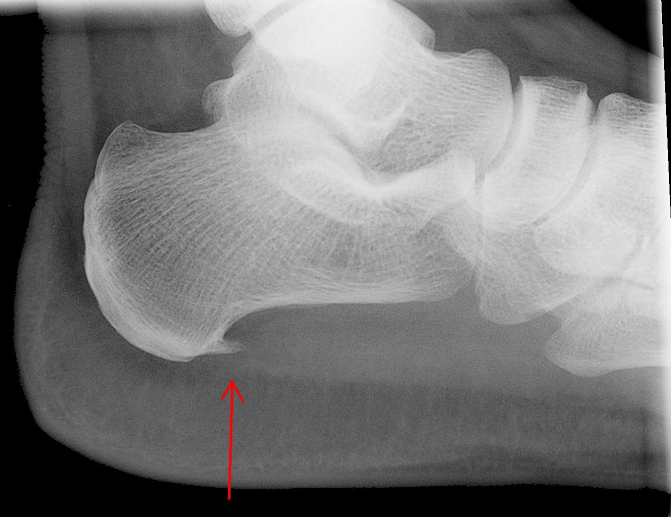 projectional_radiography_of_calcaneal_spurjpg